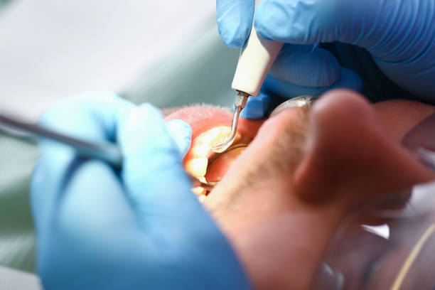 Best Dental Abscess Treatment in Fearrington Village, NC